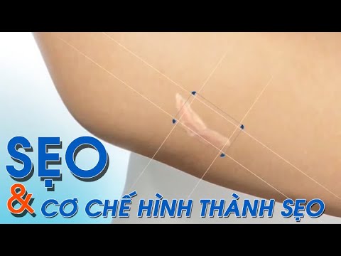 ✪ Cách trị sẹo lồi lâu năm cực HOT những ngày gần đây