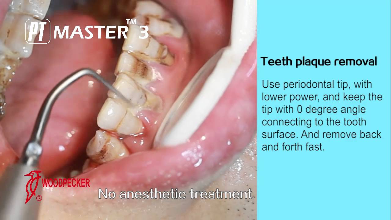 WOODPECKER PT MASTER 3 Scaler Medicine Wing YouTube