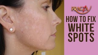 How to Get Rid of White Spots on Kids' Faces | Dr. Shehla Aggarwal (Dermatologist)