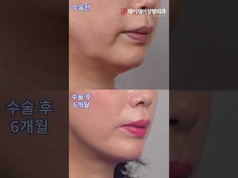 전후 사진) 안면거상 리프팅#심부볼 #<strong>안면거상술</strong> #shorts