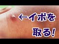 【イボ除去】イボとりオジサン #1