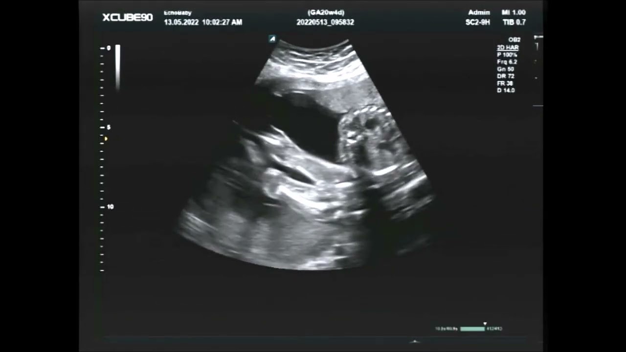 Zwangerschapsecho Tweeling 20 Weken, Filmpje Met Geslachtsbepaling