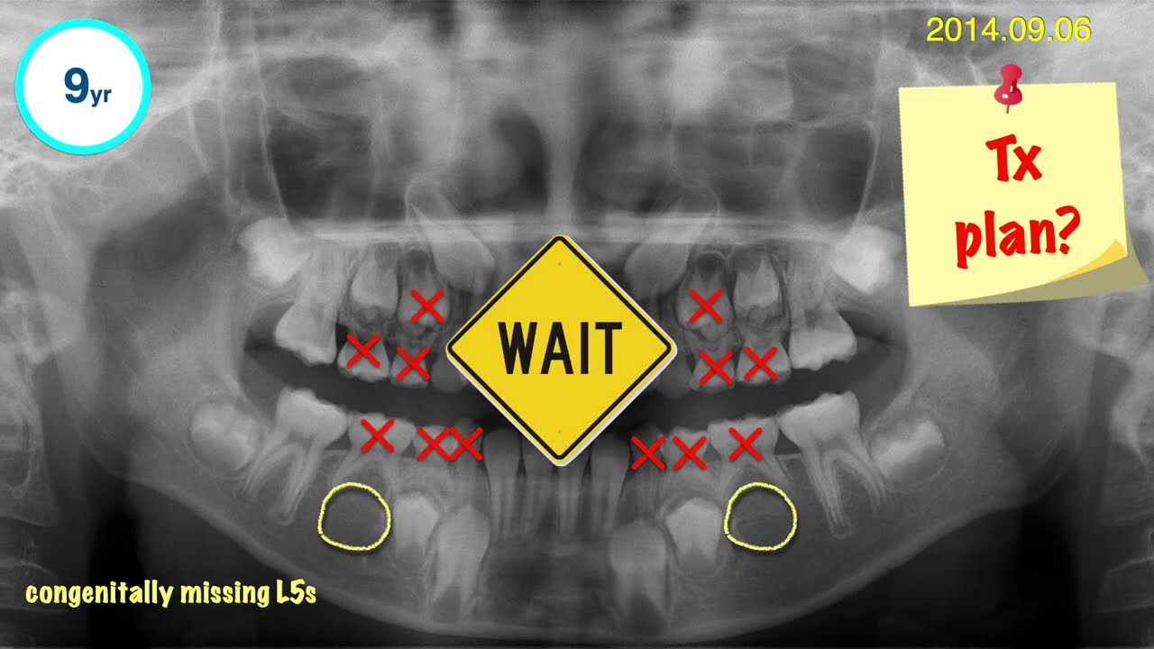 【裁断済】Functional Occlusion Class III + Functional Shift + Congenital Missing L5s｜【Chris