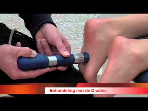 Video: Shockwave-therapie Voor Hielspoor - Voor- En Nadelen