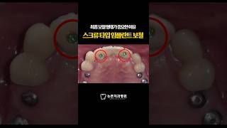 [부산임플란트치과] 최종 보철 형태가 중요한 이유 &quot; 스크류 타입 임플란트 보철 &quot; #shorts