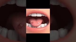 Why mouth ulcers happen #facts #facts