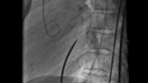 trans septal puncture  #transseptalpuncture #septalpuncture #septalaccess #septostomy