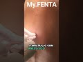 RECONSTRUÇÃO DE TRANSITO INTESTINAL: CATETER EPIDURAL