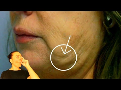 3 MASSAGE techniques to get rid of MARIONETTE LINES and lift mouth corners