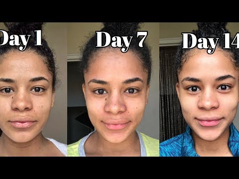 HOW TO GET RID OF ACNE DURING PREGNANCY NATURALLY( Real Results)( Vlogmentary)