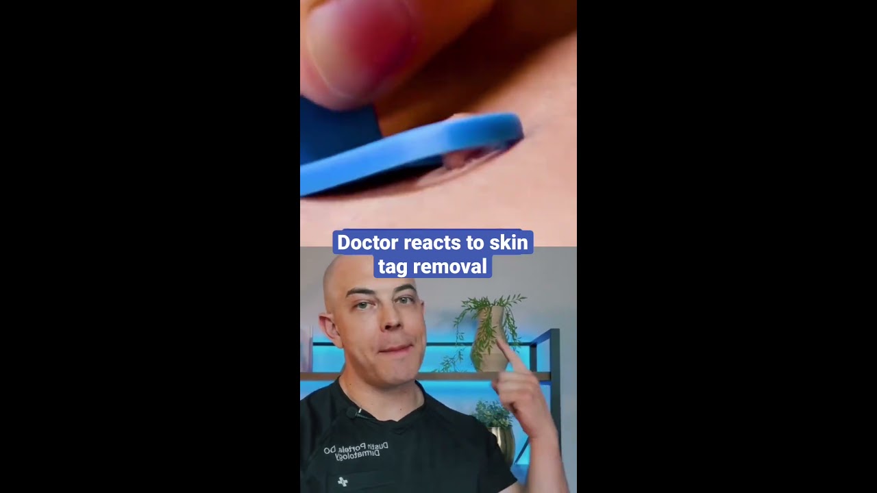 Doctor Reacts To Skin Tag Removal 