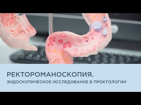 Ректороманоскопия. Эндоскопическое исследование в проктологии