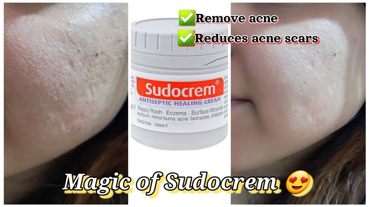 Sudocrem For Acne How To Use Sudocrem It s Benefits One Skincare Sudocrem For Acne How To Use Sudocrem It s Benefits One Skincare