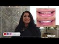 Darya abdulkerim hollywood smile makeover in antalya  i got veneers in turkey