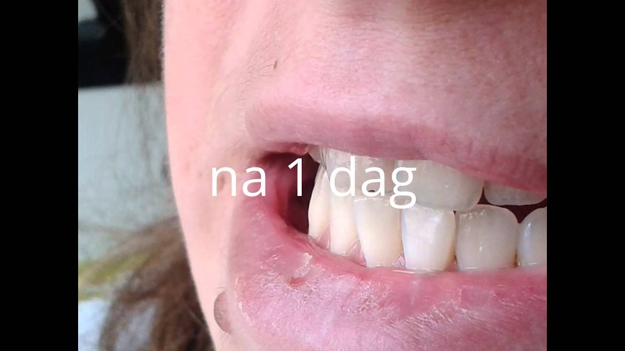 White teeth in 3 days.. - YouTube