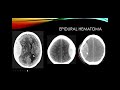 CSF and Meninges