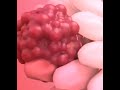 Are U Looking for Cancer