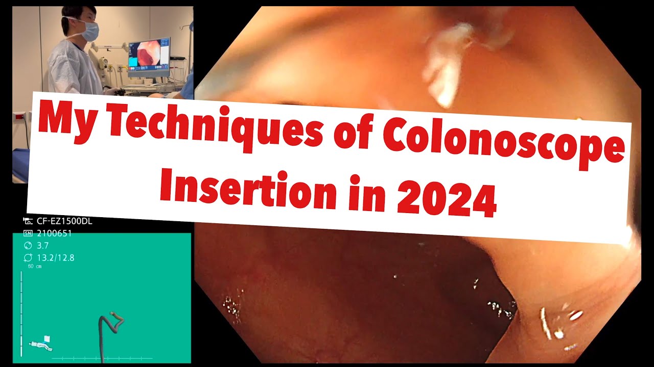 Colon Clip Colonoscopy insertion: How I do Colonoscope insertion in 2024 - YouTube