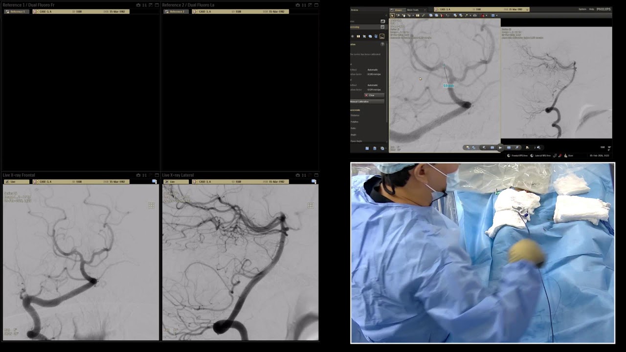 Case-3, PCA-infundibulum, 05-02-2026