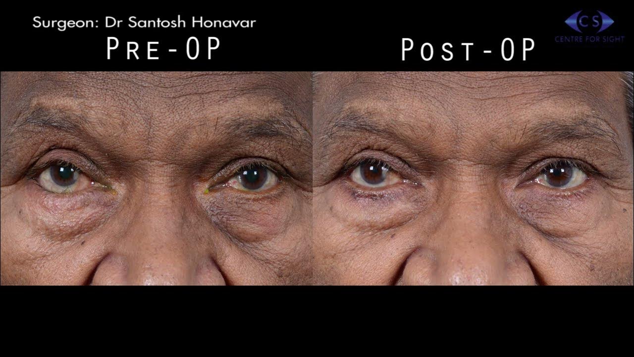 Entropion Correction Jones Procedure YouTube