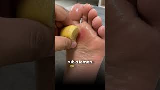 Foot Corn Treatment Explained