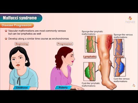 माफ़ुची का सिंड्रोम - एनिमेशन