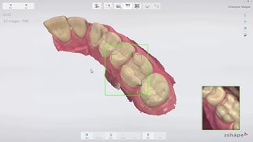 3Shape TRIOS - Workflows für Inlays, Onlays und Veneers