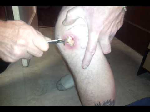 Picking a scab the "Pistol Pete" way! - YouTube