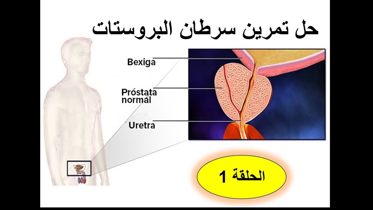 علوم طبيعية تمرين سرطان البروستات تفكيك السياق