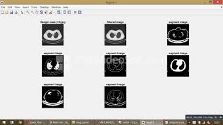 lung cancer diagnosis system using cuckoo search optimization and support vector machine classifier