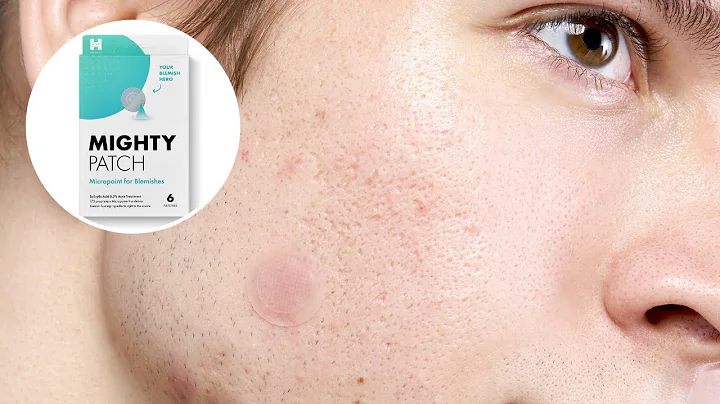 Your Early-Stage Acne Hero: Micropoint for Blemishes | Hero Cosmetics