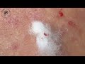 Satisfying Blackhead & Pimple Extraction ASMR — Giant Forehead Pus Burst! Part 2