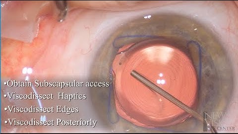 IOL Exchange with Removal of 2 year old Symfony / Restor Multifocal IOL 4k