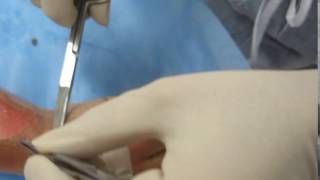 Burn Wound Debridement