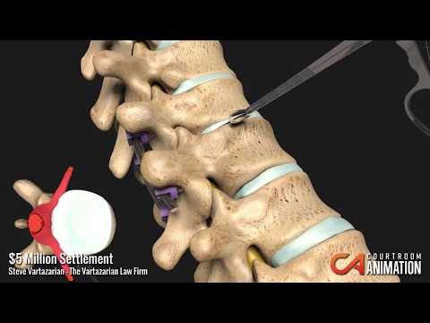 Diskectomy - Medical Animation