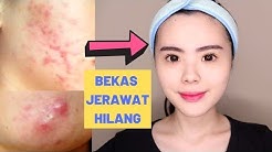 5 CARA AMPUH MENGHILANGKAN BEKAS JERAWAT SECARA ALAMI (PENGALAMANKU)  - Durasi: 10.21. 