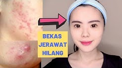 5 CARA AMPUH MENGHILANGKAN BEKAS JERAWAT SECARA ALAMI (PENGALAMANKU) - Durasi: 10.21. 5 CARA AMPUH MENGHILANGKAN BEKAS JERAWAT SECARA ALAMI (PENGALAMANKU) - Durasi: 10.21.