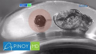 Pinoy Md Bato Sa Apdo, Paano Maiiwasan?