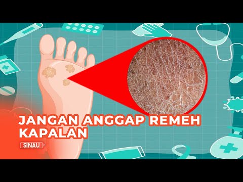 Video: Adakah kapalan hilang?