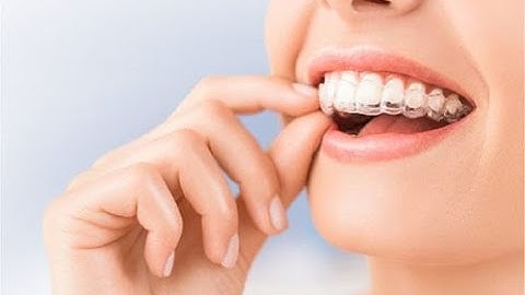 Lợi thế của niềng răng trong suốt Smilesalign