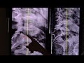Gonstead Chiropractic Before and After XRay Comparison Case Study for a 79 yr. Old Woman