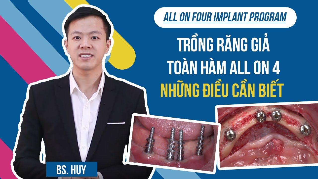 Outline Video Trồng răng giả implant nguyên hàm all on 4 – Những điều cần biết