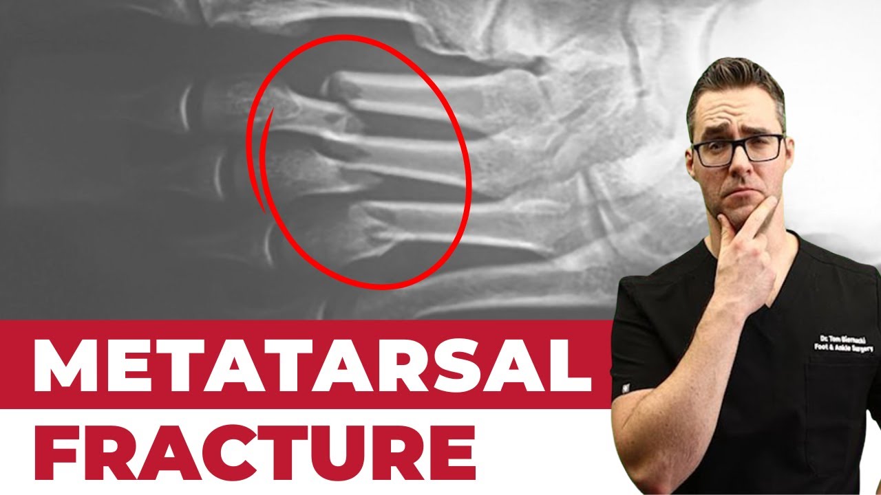 Metatarsalgia & Metatarsal Stress Fractures [Home Treatment!] YouTube