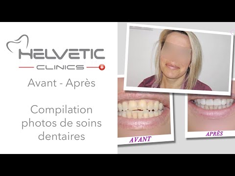 Avant Après - Compilation photos de soins dentaires