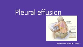Pleural Effusion, Causes, Pleural Fluids Ysis, Thoracentesis, Exudative And Transudative