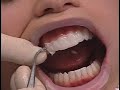 Jill a lumineers veneers clinical case study  denmat dental education