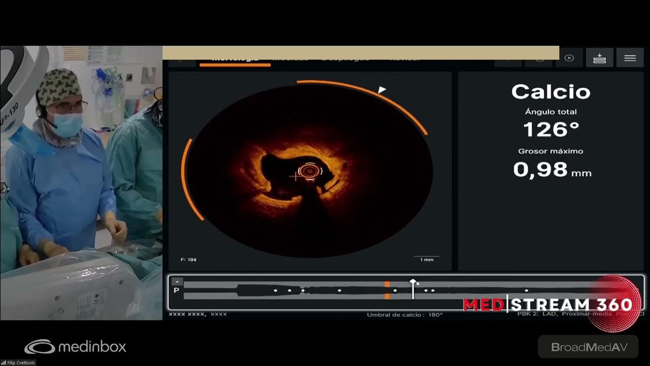 Oct guided pci to lda using ivl youtube