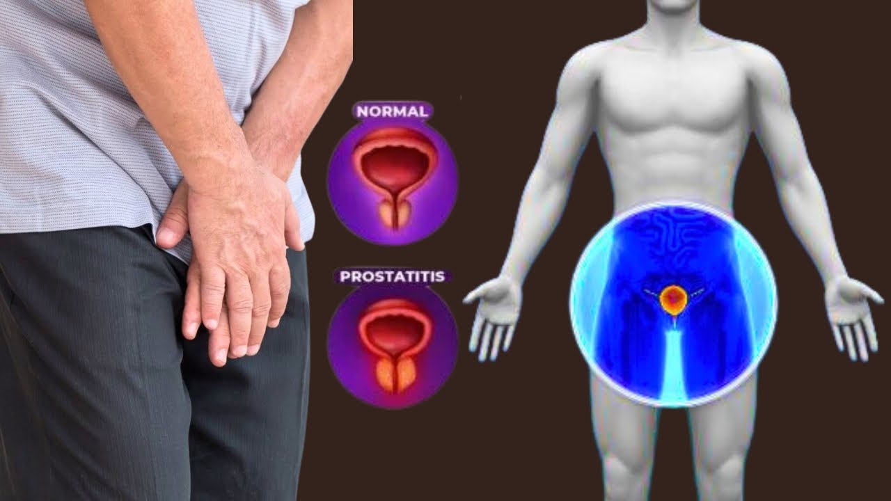 best treatment for bph and ed 🔥 male prostate infection 🔥 prostatitis