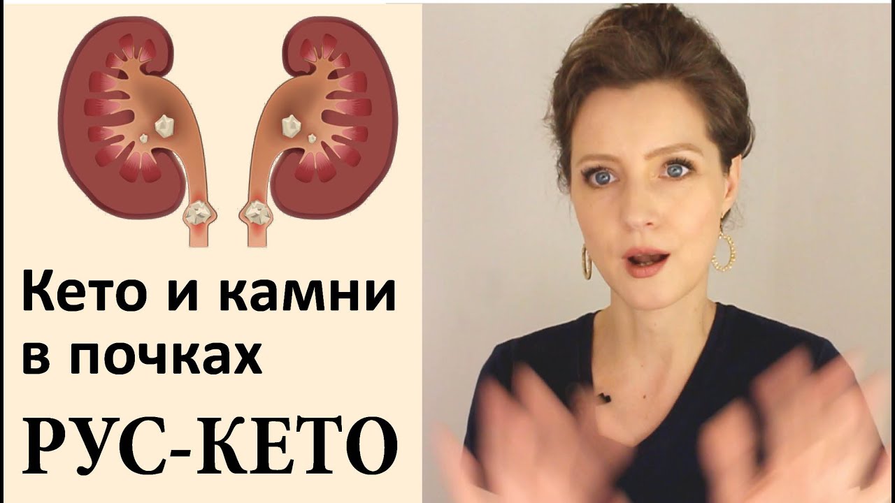 Кето-диета и камни в почках - YouTube