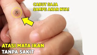 Kapalan dan Mata Ikan Hilang Selamanya dengan 2 Cara Ini